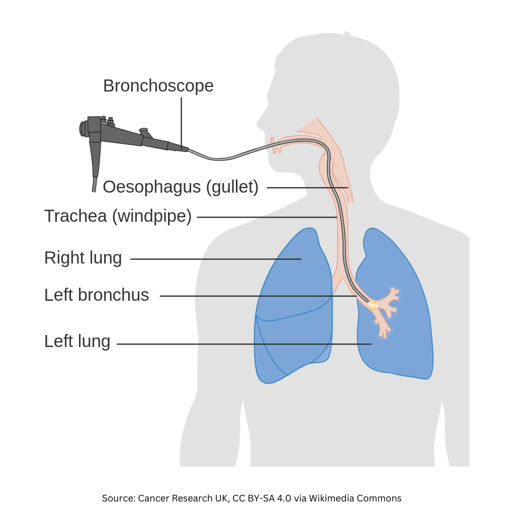 Diagram of a bronchoscope connected to a person's lungs.